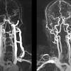 Since this type of stroke presents with nonspecific symptoms, receiving treatment may be delayed. 1
