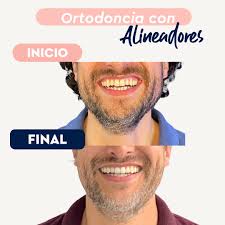 Te contamos en este post los ingredientes que usamos en esta sonrisa:  -Ortodoncia con Alineadores. -Acalaramiento Dental. -Diseño y  reconstrucción de bordes incisales. Cuando mezclamos estos tres elementos y  añadimos la colaboración