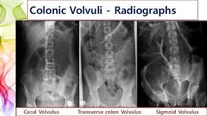 Image Result For Cecal Volvulus Image General Surgery Radiology