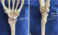 Volar Plate-Suture Fixation in the Treatment of Volar Rim ...
