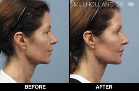 Voluma cheek fillers before & after vlog | solange nicole. Restylane Injectable Toronto See Restylane Before Afters