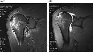 Hagl dannes av underkjølte vanndråper som fryser rundt en kondensasjonskjerne, som et støvfnugg eller en annen haglpartikkel. An Anterior Humeral Avulsion Of The Anterior Glenohumeral Ligament Download Scientific Diagram