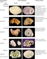 Comprehensive Morpho Constitutional Analysis Of Urinary Stones Improves Etiological Diagnosis And Therapeutic Strategy Of Nephrolithiasis Sciencedirect