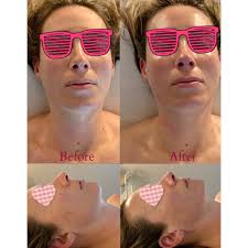 Hi! These are a few of my client's before and after pics from their 60 min  Sculpting Buccal sessions which help reduce swelling, increase circulation  and collagen production, and improve the gravitational