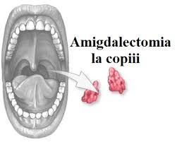 În afara carbohidratului c, la nivelul peretelui se afla si proteina m, care are un efect antifagocitar. Amigdalectomia Indepartarea Chirurgicala A Amigdalelor Newsmed Ro