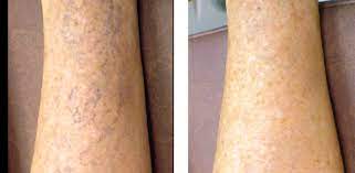 Însă nu este o regulă ca vasele de sânge sparte să se. Vinisoarele Inestetice Pot Fi Tratate Cu Laser La Clinica Fazzada