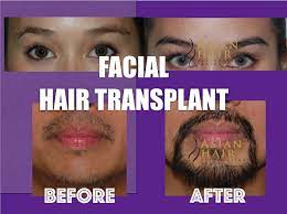 Facial hair restoration reintroduces hair to areas, where facial hair growth is thin or missing. Facial Hair Transplant Our Natural And Impressive Results