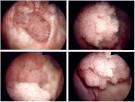 Cancer de laposoesophage : cause, symptme - Ooreka