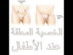 تعرف على اسباب وعلاج الخصية المعلقة عند الاطفال د وائل غانم الطبيب youtube