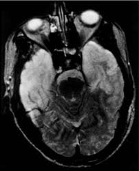The mri most frequently shows bilateral areas of high t2 intensity. Viral Encephalitis And Epilepsy Misra 2008 Epilepsia Wiley Online Library
