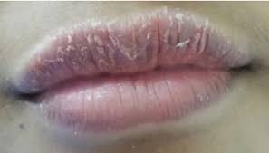 Pdf Allergic Contact Cheilitis Due To Lipstick Semantic Scholar