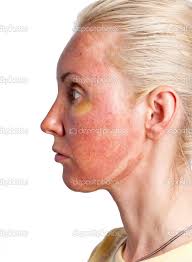 How To Treat A Chemical Peel Burn Ehow Chemical Face Peel Chemical Peel Chemical Burn