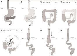 Colonic anastomosis, peritonitis, phospholipase activity, redox potential. Ileo Right Hemi Colonic Cervical Pull Up On A Non Supercharged Ileocolic Arterial Pedicle A Technical And Case Report