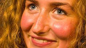 How to get rid of red face from viagra. Rosy Cheeks Rosacea Or Something Else Tips For Identification