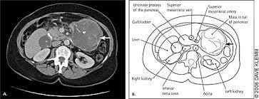 Jun 01, 2021 · pancreatic ductal carcinoma (pdac) is a highly lethal cancer, and early detection and accurate staging are critical to prolonging survival. Pancreatic Cancer Diagnosis And Management American Family Physician