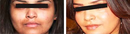 Bleach it real good on the hole, anal bleaching is a safe cosmetic treatment that can boost. Laser Hair Bleaching Laser Bleaching Hair Bleaching Laser In Mumbai