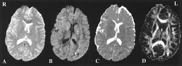 Image result for Diffuse Axonal Injury