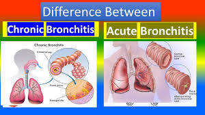 Image result for Acute Bronchitis