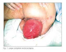 Anemia Grave Por Prolapso Rectal