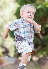 Morquio Syndrome Causes Symptoms Diagnosis Life Expectancy Treatment