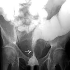 Image result for Radiation Colitis