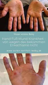 Hand Mund Fuss Bei Erwachsenen Ansteckend Und Schmerzhaft