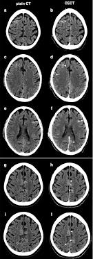 A computed tomography (ct or cat) scan allows doctors to see inside your body. Pathological Brain Ct Scans In Severe Covid 19 Icu Patients Springerlink