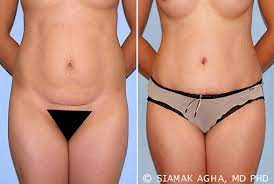 The cost can range from $8,000 to $15,000, plus anesthesia and other extras. Dr Siamak Agha Does Insurance Cover Tummy Tuck