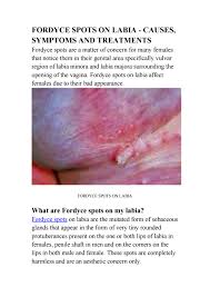 Dec 23, 2020 · some of the natural remedies that may help remove fordyce spots include: Fordyce Spots On Labia Removal Uk By Ppp Treatment Uk Issuu