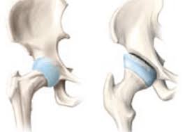 La coxarthrose correspond à l'arthrose de la hanche. Coxarthrose Huftarthrose Entstehung Konservative Massnahmen Arthroskopie Endoprothetik