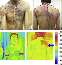 Your lung cancer may come back in your lungs. A Case Of Lung Cancer With Unilateral Anhidrosis And Contralateral Hyperhidrosis As The First Clinical Manifestation Journal Of The American Academy Of Dermatology