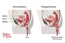 Image result for Rectal prolapse