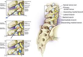 Consensus Practice Guidelines On Interventions For Lumbar Facet Joint Pain From A Multispecialty International Working Group Regional Anesthesia Pain Medicine