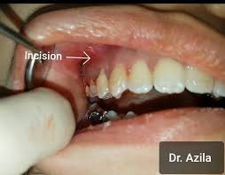 Baca untuk ketahu cara hilangkan bengkak gusi yang bengkak gusi, dia punya sakit memang tak boleh bincang. Pakai Braces Lebih Tiga Tahun Sudahnya Bengkak Muka Gigi Rosak Teruk Mingguan Wanita