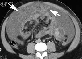 Its radiographic manifestations consisted of a desmoplastic mesenteric process with or without a localized mass displacing gastrointestinal structures. Primary Peritoneal Tumors Imaging Features With Pathologic Correlation Radiographics