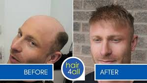 How to Apply (Attach) a Non-Surgical Hair Replacement System for Men with  our Client Steve