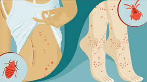 Bug Bite With Black And Blue Ring Around It Chigger Bites Vs Bed Bug Bites Telling Them Apart