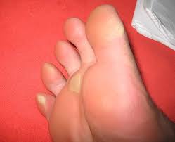 You must not do this too many times because your skin will be thinned very quickly. Remove Dead Skin From Your Feet Using These Home Remedies