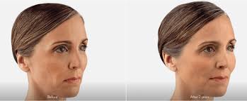 Dermal Fillers smooth wrinkles & fine lines, skin treatment