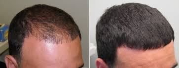 One method for hair loss that you have possibly heard about is derma rollers. Derma Roller For Hair Growth