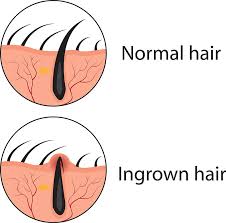 You can get ingrown hairs anywhere you grow hair, whether it's ingrown leg hair, ingrown pubic hair. Ingrown Hair Healthdirect