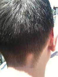 It can affect the skin on any part of the body melanin is responsible for the colour of our skin, eyes and hair. Pin On Vitiligo