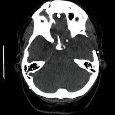 Pin On Craniopharyngioma