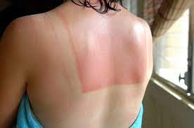How To Treat A Bad Sunburn (+ A Few Tips For Avoiding It In The First  Place!) - Center For Plastic Surgery