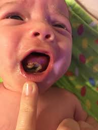 Babies with anterior tongue ties cannot move their tongue forward over their gums. Black Spots In Tongue After Cutting Tongue Tie Pic July 2018 Babies Forums What To Expect