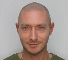 New Contour Scalp Micropigmentation (SMP)