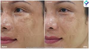Image result for Melasma