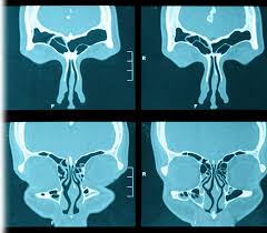 Image result for Sinus CT