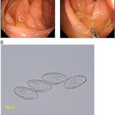 We did not find results for: Photographs Of Enterobius Vermicularis And Scotch Tape A Download Scientific Diagram