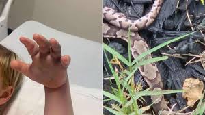 Image result for Snake Bite